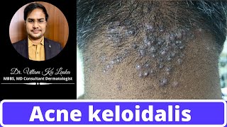 Reason and Treatment of pimples on neck/back side of head(Acne keloidalis) | By MBBS Dr Uttam Lenka