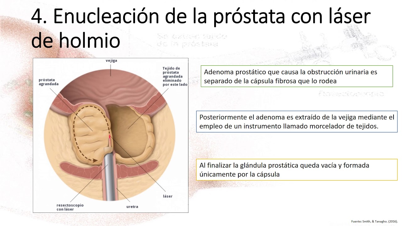 32 prostatitis vagyok