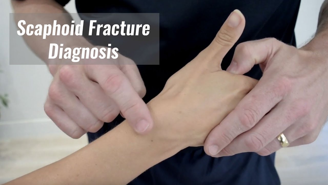 scaphoid fracture tests)