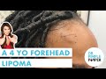 A 4 year old Forehead Lipoma