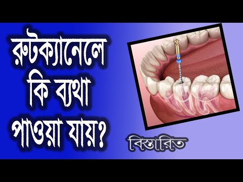 ভিডিও: ডেনচার কেনার W টি উপায়