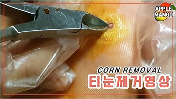 corn removal 티눈제거 (ft.생살을 찢는 고통)