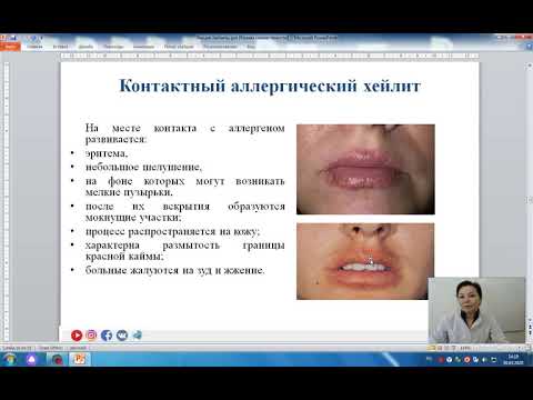Видео: Хейлит на устните - класификация, лечение
