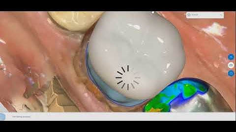 Rachel Designing Tooth #30 CEREC Crown:)