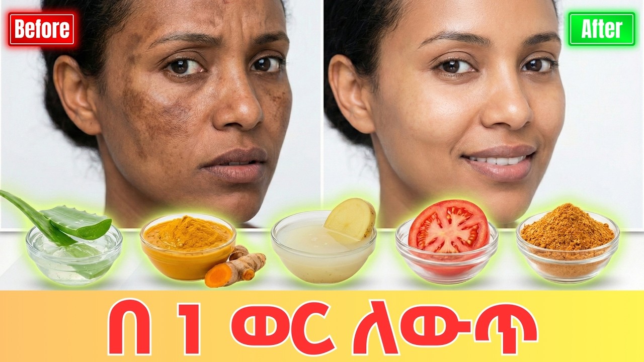 ፊትዎ ላይ ሎሚ መቀባቱን አሁኑኑ ያቁሙ! ማድያትን ለማጥፋት የምንሰራቸው 3 ትላልቅ ስህተቶች