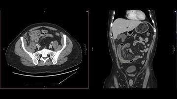 Abdominal Imaging Call Prep Cases: Perforated Appendicitis (CT) Case 3 Discussion
