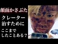 レーザーやダーマペンでクレーターは治らない？【いや、僕、結構治ったんだけど！】