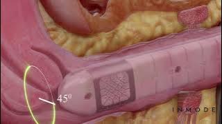 Morpheus8V - How It Works