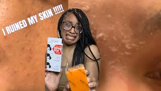 KOJIC ACID SOAP RUINED MY SKIN !!!! | WITH PHOTOS | FAIL | Kojie San Skin  Lightening Soap |