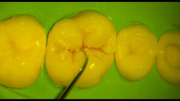 Upper First Molar Composite Restoration. Cusp by Cusp buildup technique.