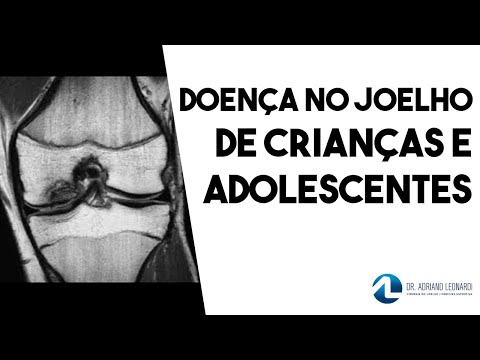 OSTEOCONDRITE DISSECANTE DO JOELHO: Doença em crianças e adolescentes