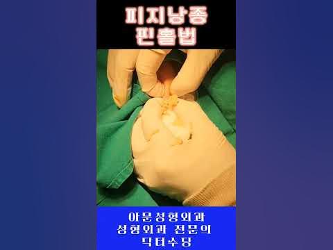 피지낭종 핀홀법! (표피낭종 성형외과 피부 종양 수술 서울)[아문Tv] - Youtube