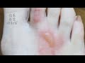 【閲覧注意】熱湯を足にこぼすとこうなる😱やけど治癒経過
