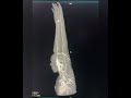 CT Scan Venography 3D image