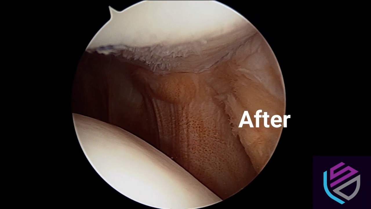 Chondromalacia Patella Narrated Arthroscopic Surgery for