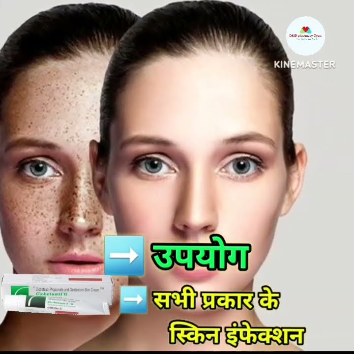 Clobetamil G Cream Clobetamil G Cream Use In Hindi Clobetamil G clobetamil-g-cream-clobetamil-g-cream-use-in-hindi-clobetamil-g