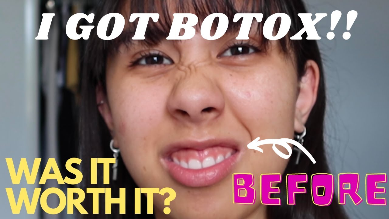 I GOT GUMMY SMILE BOTOX?! DID IT WORK?