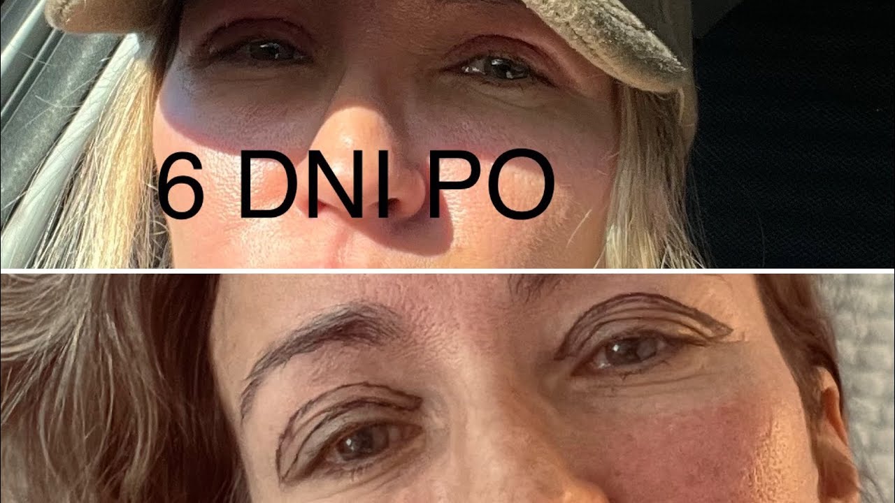 Czy Można Poprawić Sprawdzian Po 2 Tygodniach Blefaroplastyka - zrobilam powieki🇩🇰Czy bolalo? Zabieg, gojenie… - YouTube