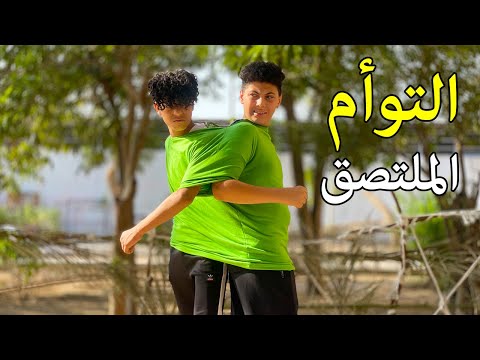 التوأم الملتصق يدخلان صراع ضد بعضهما من أجل البقاء