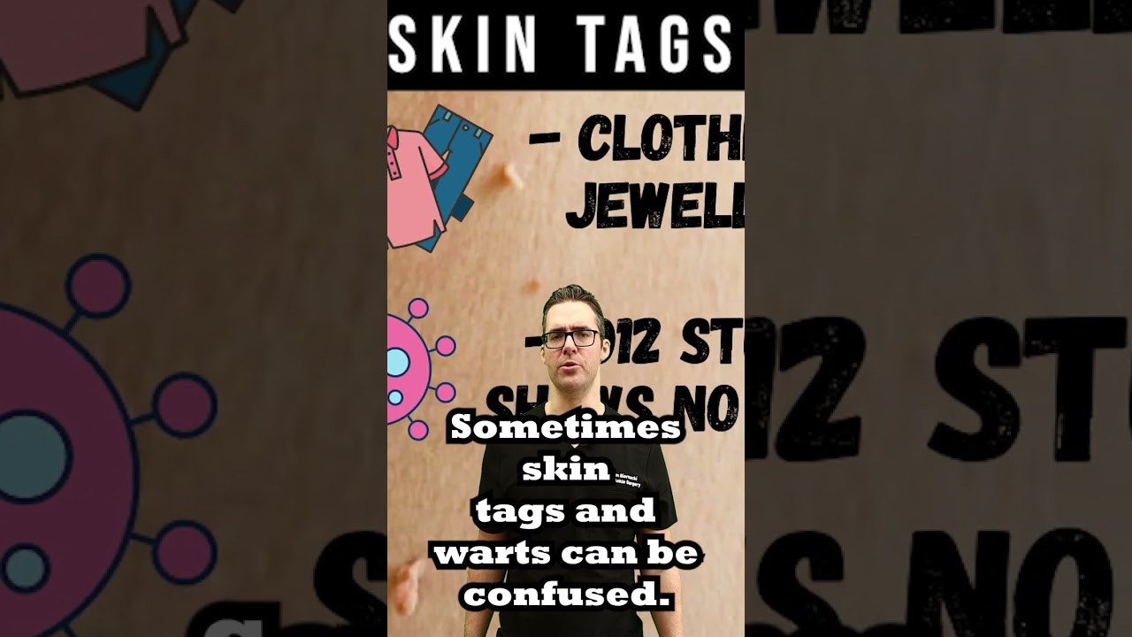 What Causes Skin Tags? [What are Skin Tags? ]