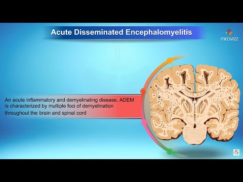 Video: Acute Disseminated Encephalomyelitis: Symptoms, Treatment, Consequences