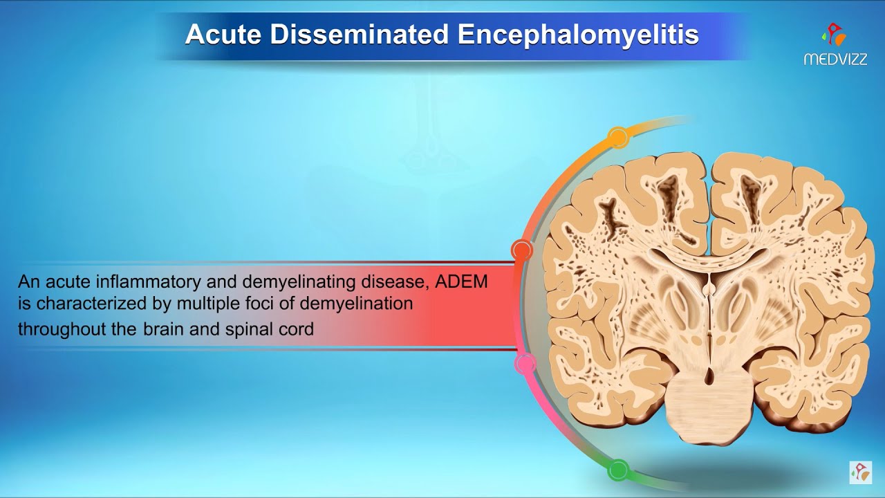 Acute Disseminated Encephalomyelitis Neurology YouTube Acute Disseminated Encephalomyelitis Neurology YouTube