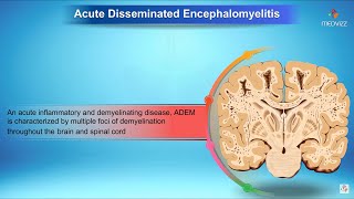 Acute disseminated encephalomyelitis - Neurology