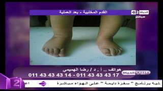 طبيب الحياة - بالصور القدم المخلبية أسبابها وطرق علاجها - د. رضا الهميمي - إستشاري جراحة العظام