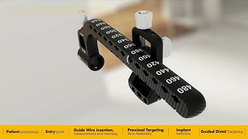 T2 Alpha Femur Antegrade GT/PF Nailing System | Surgical Animation