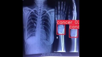 Bone Tumor Cancer Detection Yolov8| Computer Vision|Healthcare|Yolo|Project