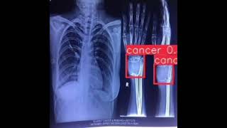 Exclusive Bone Tumor Cancer Detection Yolov8| Computer Vision|Healthcare|Yolo|Project Profile