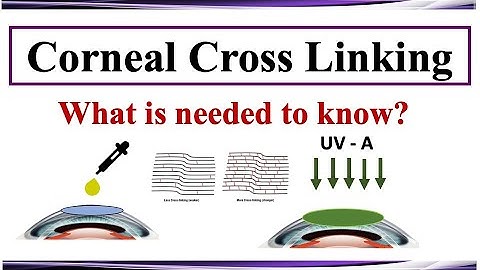 Corneal Cross Linking: Protocols and Literature Review
