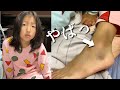 【怪我】捻挫した足がヤバイ事に…突然青あざが浮き出てきた！【育児Vlog】