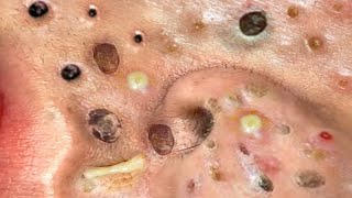 Loan Nguyen Acne Treatment 11y