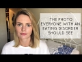 The Photo Everyone with an Eating Disorder Should See (WARNING: GRAPHIC IMAGE)