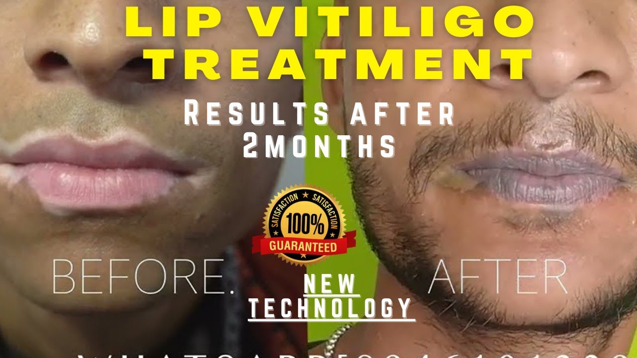 Lip Tip Vitiligo Treatment 100 Healed Video Of Lip Vitiligo Lip