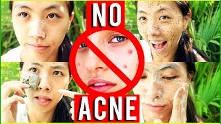 We've all been victims of acne. do you hate pimples, pores, or
blackheads? dark undereye circles? don't fear! watch and learn how to
get clear, bright & acne...