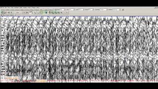 Learn to Read EEGs   Part 3