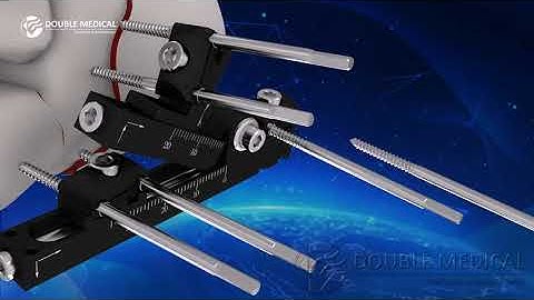 External Fixator for Calcaneus