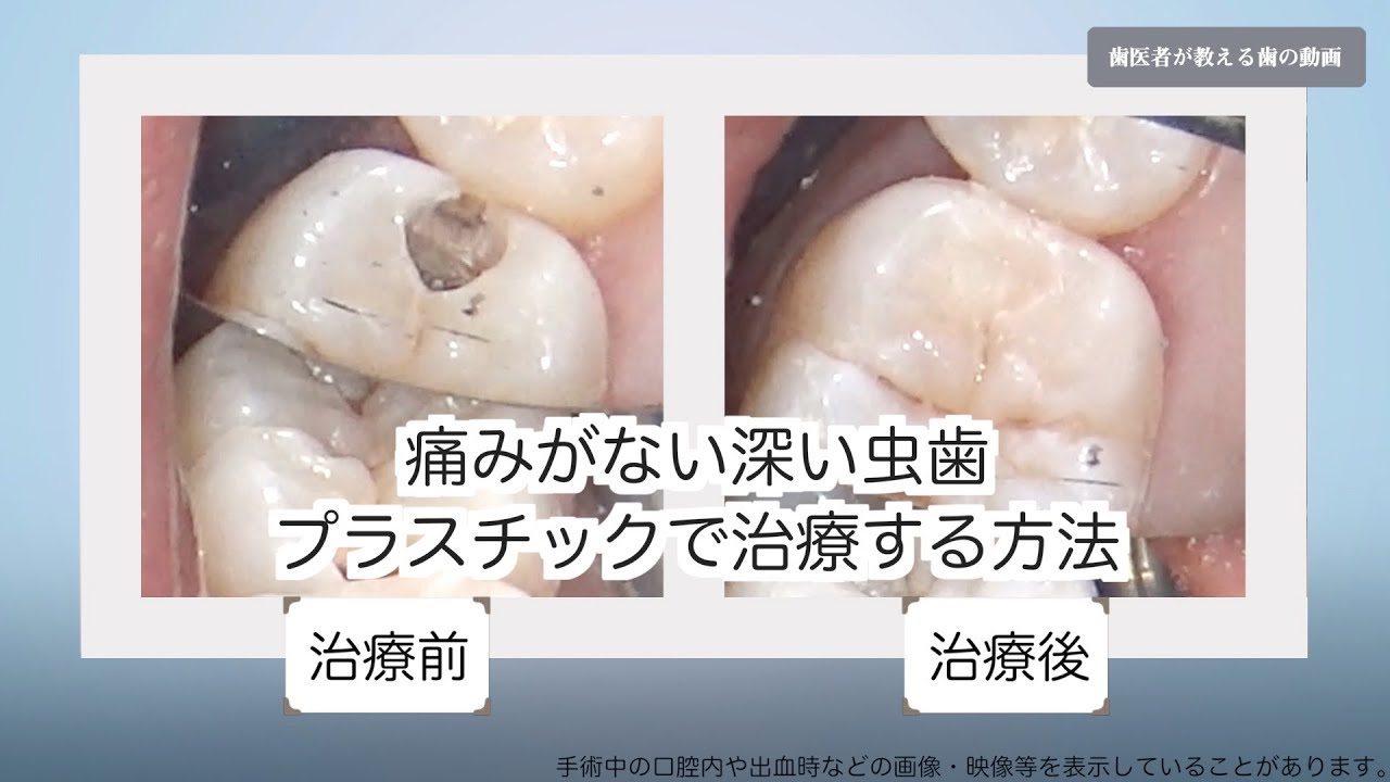 虫歯の意外な事実 現役歯医者があなたに指摘する虫歯の原因と対処法