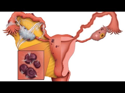 Video: Endometrioza Medeničnega Peritoneuma - Simptomi, Zdravljenje In Vzroki