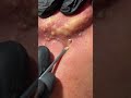 Skincare removal