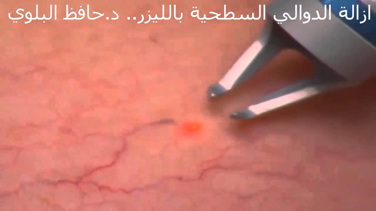 علاج الدوالي بالليزر .. د.حافظ البلوي