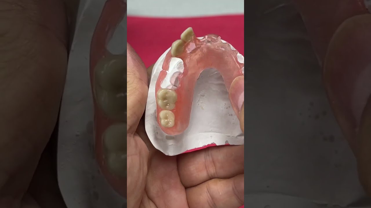 Replacing 6 Teeth With A FiberFlex Partial