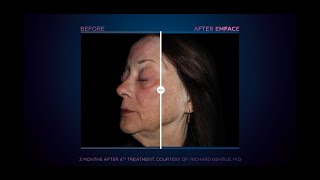 EMFACE Treatment Results