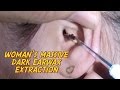 Woman's Massive Dark Earwax Extraction