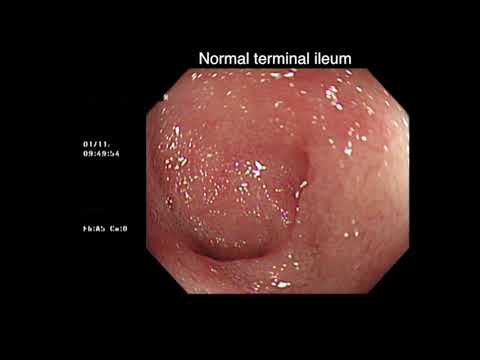 Ischaemic Colitis Two Cases - 