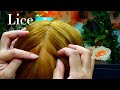 Asmr lice removal pop the lice directly on the scalp and nails 