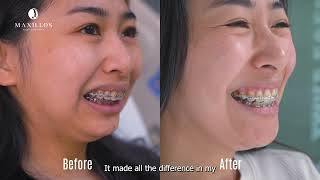 Jaw Surgery Testimonial (Class 2, Mandibular Hypoplasia) Experience at Maxillos MX, in Tijuana.