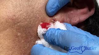 Removal Of An Epidermal Cyst Using A Punch
